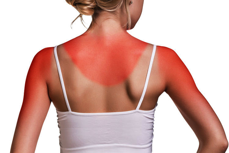 Peau brûlée = coup de soleil Peau brûlée = coup de soleil